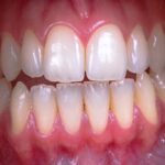 Photo AI, caries, periodontal disease, detection